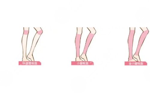 小腿吸脂恢復(fù)期要多久？有效果嗎？