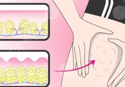 小腿吸脂恢復(fù)期要多久？有效果嗎？