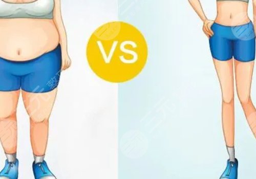 小腿吸脂恢復(fù)期要多久？有效果嗎？