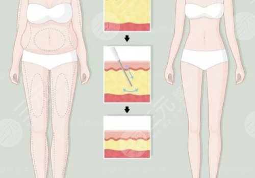 小腿吸脂恢復(fù)期要多久？有效果嗎？