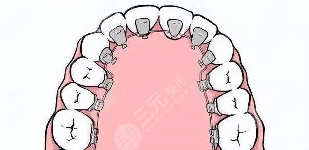 牙齒矯正相關(guān)科普
