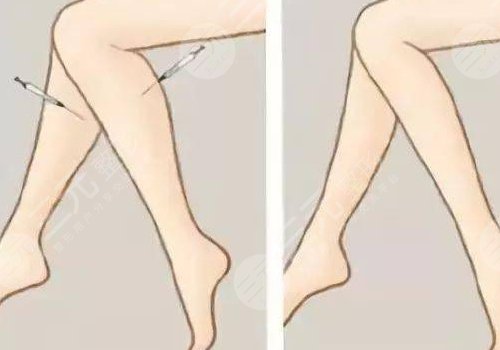 小腿吸脂后多久可以正常走路？