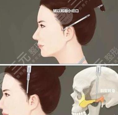 顴骨內(nèi)推