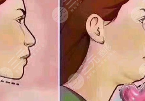 下頜緣輪廓注射多少錢？能維持多久？