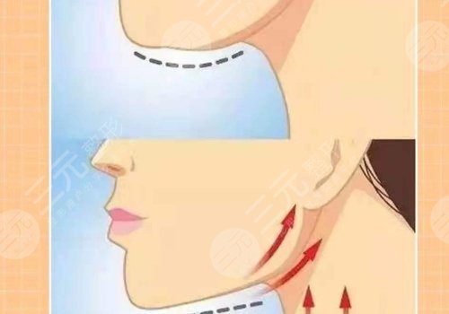 下頜緣輪廓注射多少錢？能維持多久？