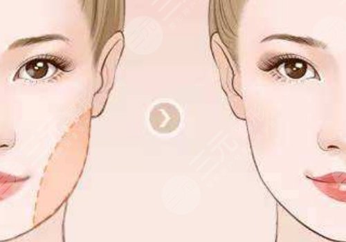 下頜緣輪廓注射多少錢？能維持多久？