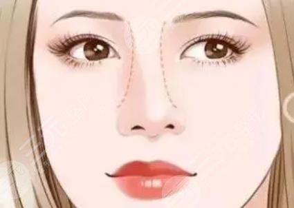 歪鼻矯正