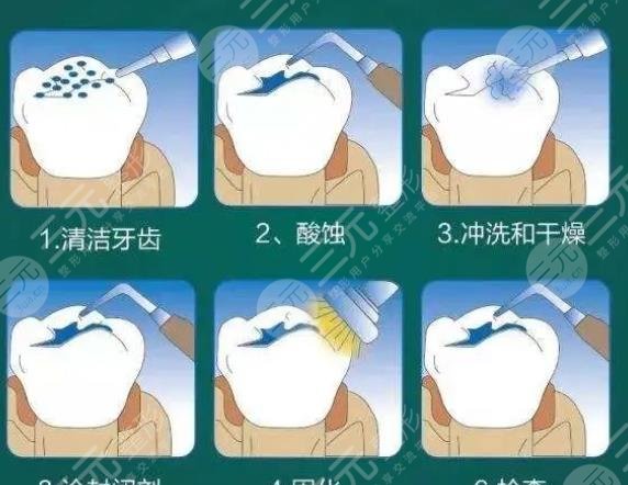 超聲波潔牙