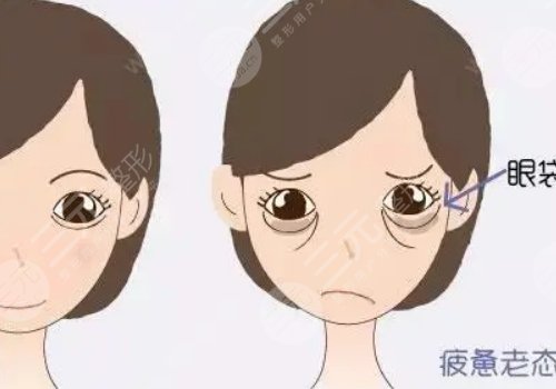眼袋是怎么產(chǎn)生的？如何消除眼袋？