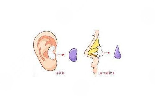 隆鼻假體取出來后能恢復到以前嗎？