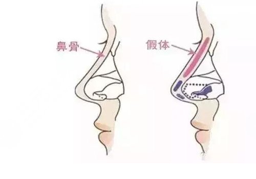 隆鼻假體取出來后能恢復到以前嗎？