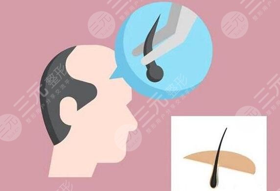 毛發(fā)種植的費(fèi)用是多少2023？價(jià)格影響根源所在，30秒速覽~