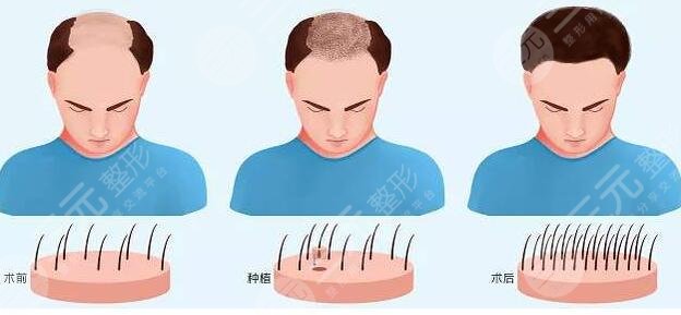 脫發(fā)護(hù)理注意事項(xiàng)