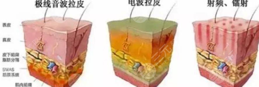 面部抗衰