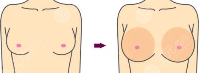 做完強(qiáng)生鉑蘊(yùn)隆胸假體需要注意什么？