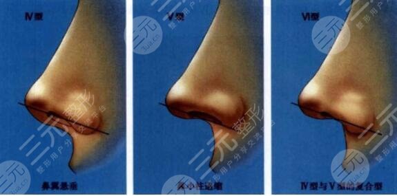 硅膠假體隆鼻價(jià)格大概多少錢？告訴你這3點(diǎn)關(guān)鍵因素影響著價(jià)位！