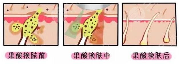 果酸換膚的注意事項(xiàng)