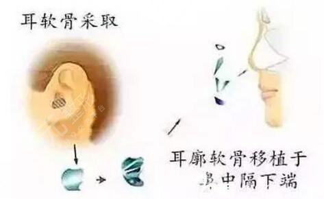 隆鼻整形手術(shù)