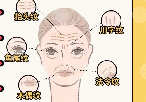 木偶紋和法令紋的區(qū)別