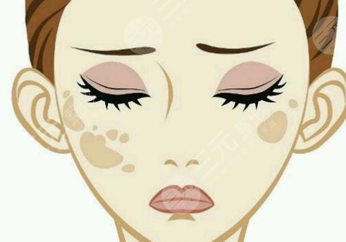 臉上長了色斑是什么原因造成的?