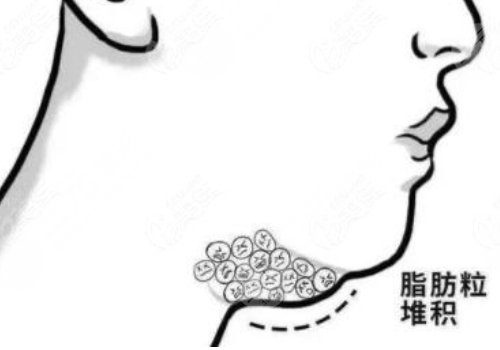 超聲炮下頜緣有必要做嗎？