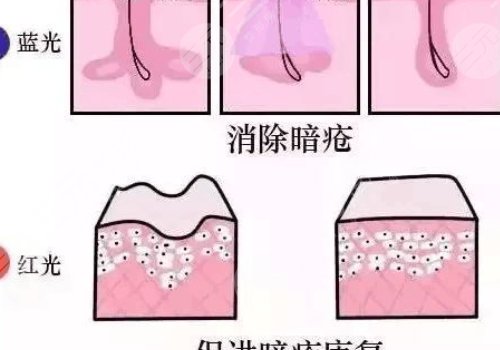 紅光緩解痤瘡能不能每天都照？