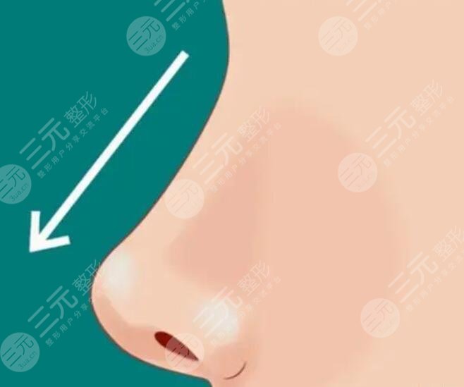 自體軟骨隆鼻材料好嗎？3大優(yōu)勢(shì)讓網(wǎng)紅明星趨之若鶩！