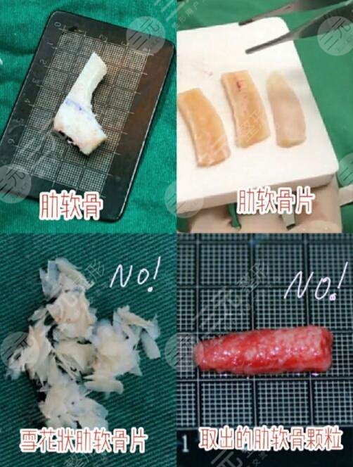 自體軟骨隆鼻的優(yōu)勢(shì)