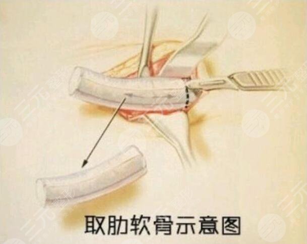 自體軟骨隆鼻的適用人群