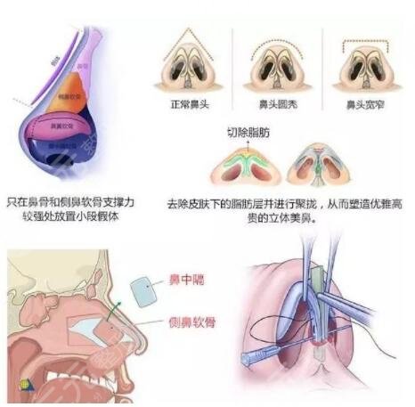 自體軟骨隆鼻的手術(shù)流程