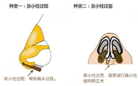 自體軟骨隆鼻的風(fēng)險(xiǎn)