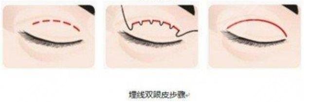埋線雙眼皮