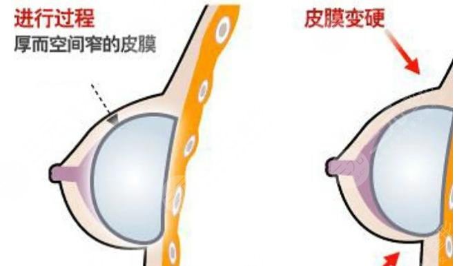 包膜攣縮