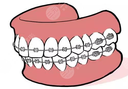 牙套價(jià)格一般是多少錢(qián)一個(gè)