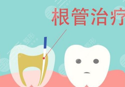 根管緩解一顆全部費用