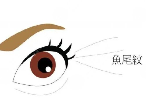 魚尾紋手術(shù)哪種好？