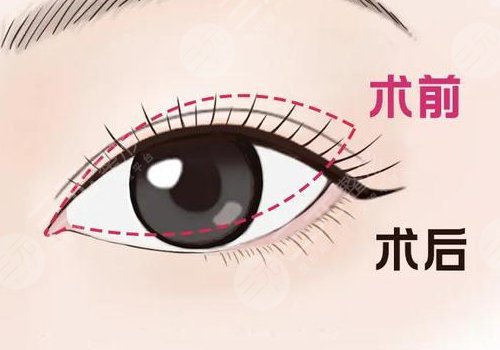 開(kāi)眼角疼不疼呢？效果如何？