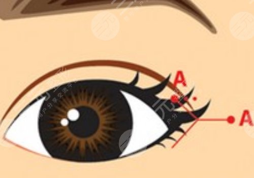 開(kāi)眼角疼不疼呢？效果如何？