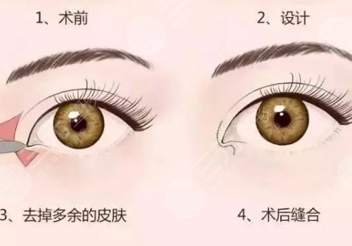 開(kāi)眼角疼不疼呢？效果如何？