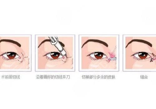 開(kāi)眼角疼不疼呢？效果如何？