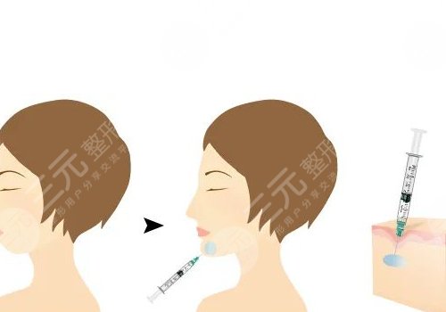 自體脂肪隆下巴多少錢？