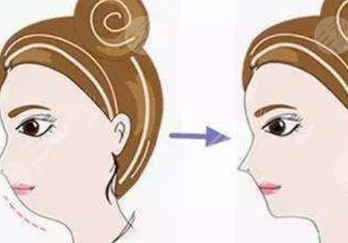 自體脂肪隆下巴多少錢？