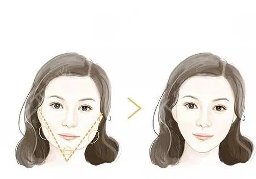 自體脂肪隆下巴多少錢？