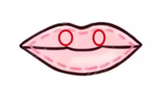 厚唇改薄能維持多久