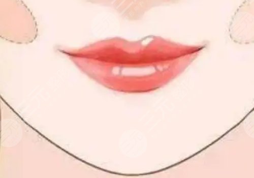 厚唇改薄能維持多久