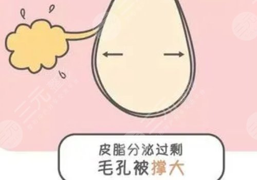 男性毛孔粗大油膩怎么改良？