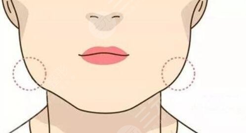 下頜角肥大怎么處理？有效的改良方式匯總，你適合哪種？
