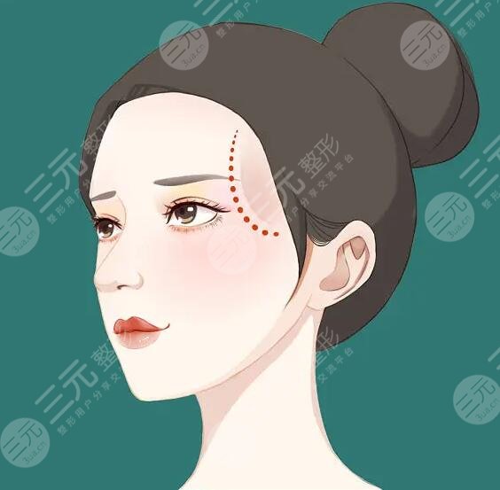 玻尿酸豐太陽(yáng)穴能保持多久？術(shù)后的注意事項(xiàng)有哪些？