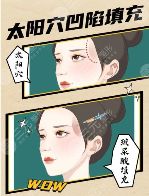 玻尿酸豐太陽(yáng)穴能保持多久？術(shù)后的注意事項(xiàng)有哪些？
