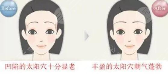 玻尿酸豐太陽(yáng)穴能保持多久？術(shù)后的注意事項(xiàng)有哪些？